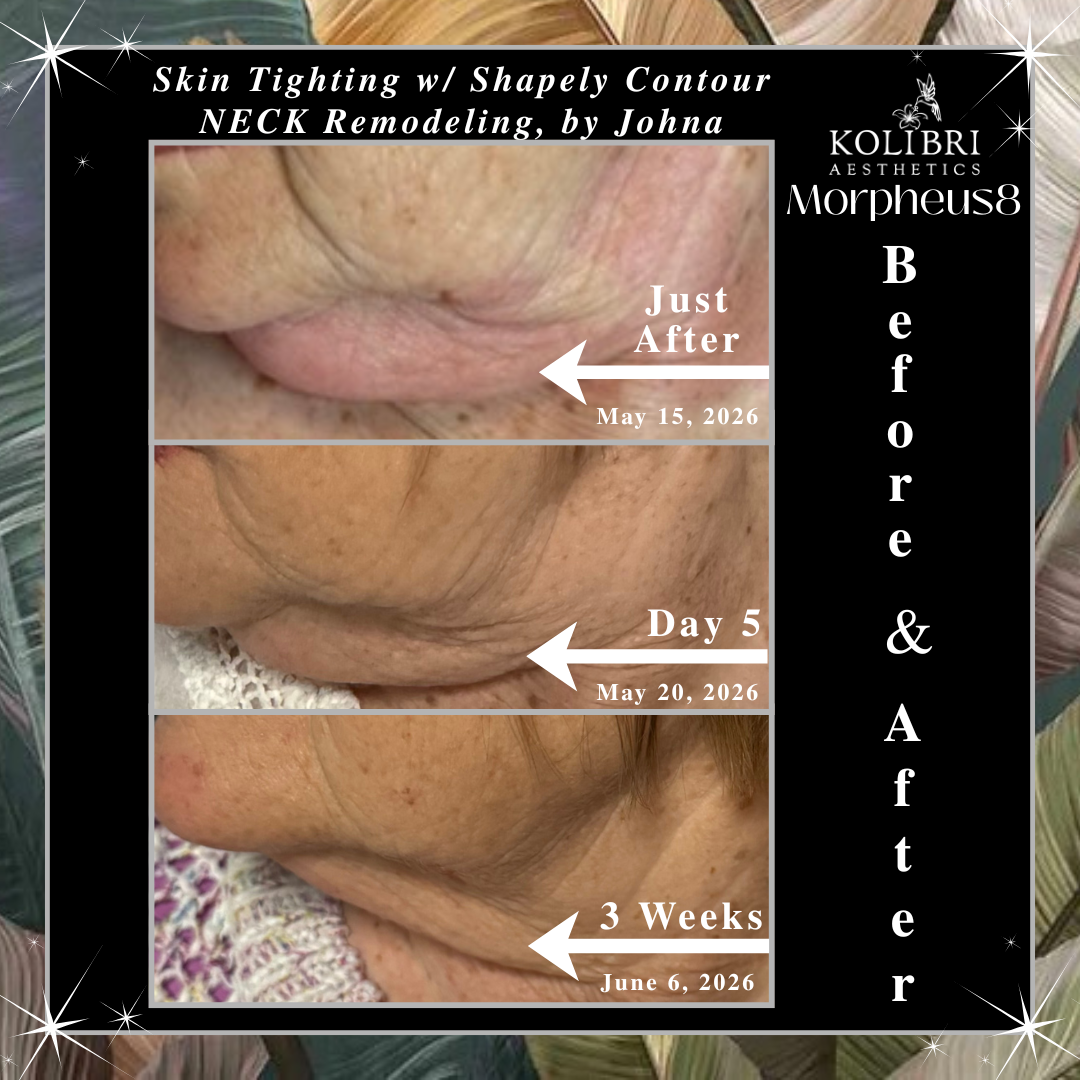 Morpheus8 skin tightening and neck remodeling before & after by Johna at Kolibri Aesthetics